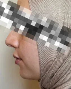 Before: Chin augmentation and jawline definition