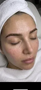 After: Congestion and texture