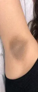 Before: Underarm pigmentation